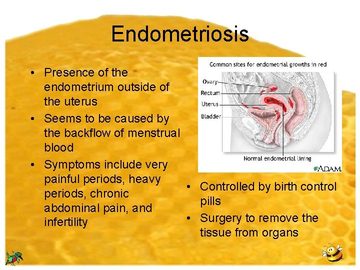 Endometriosis • Presence of the endometrium outside of the uterus • Seems to be