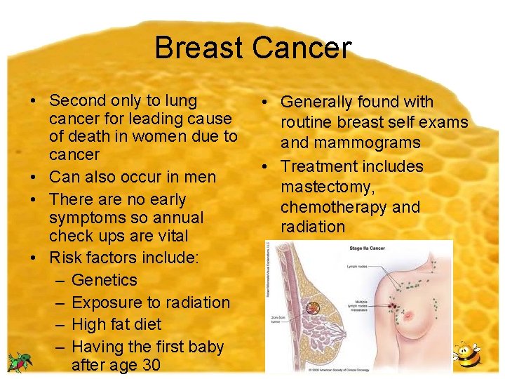 Breast Cancer • Second only to lung cancer for leading cause of death in