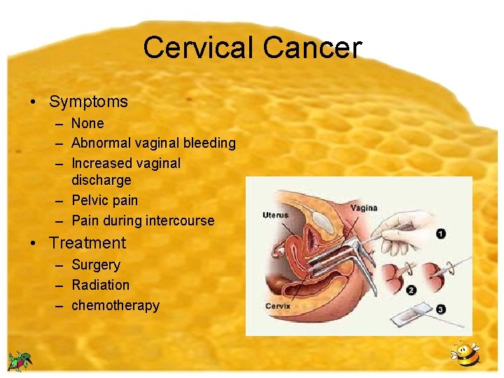 Cervical Cancer • Symptoms – None – Abnormal vaginal bleeding – Increased vaginal discharge