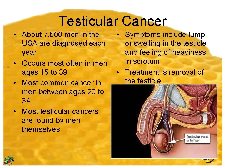 Testicular Cancer • About 7, 500 men in the USA are diagnosed each year