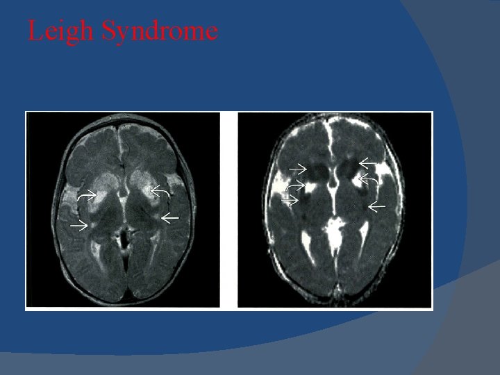 Leigh Syndrome Leigh Syndrome