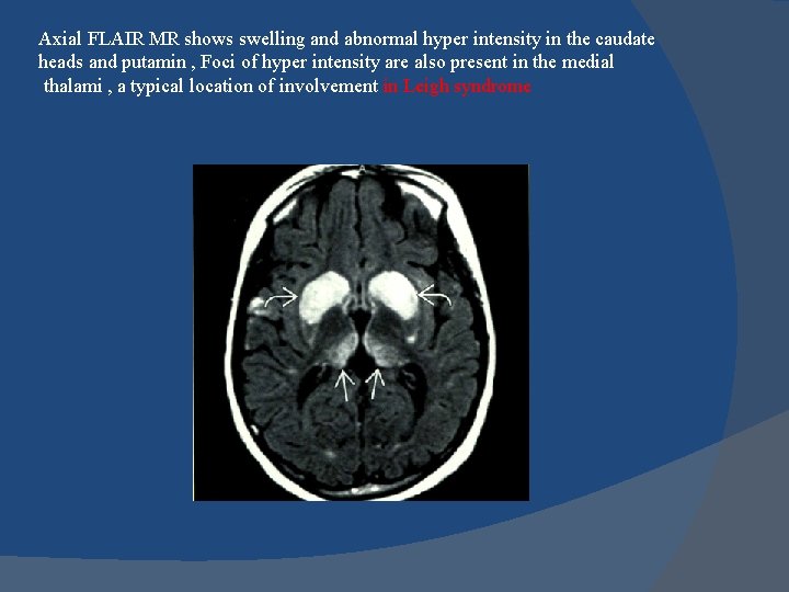 Axial FLAIR MR shows swelling and abnormal hyper intensity in the caudate heads and