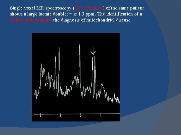 Single voxel MR spectroscopy (TE = 26 msec) of the same patient shows a
