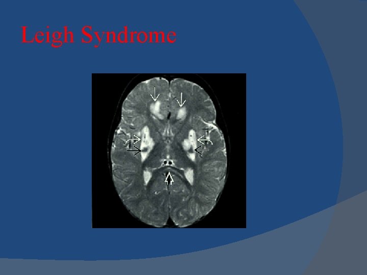 Leigh Syndrome 