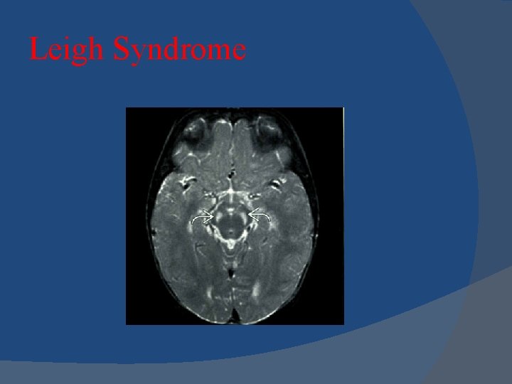 Leigh Syndrome 