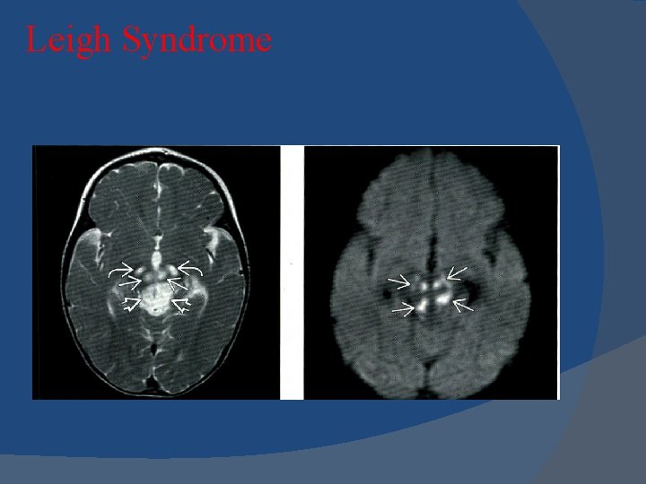 Leigh Syndrome Leigh Syndrome