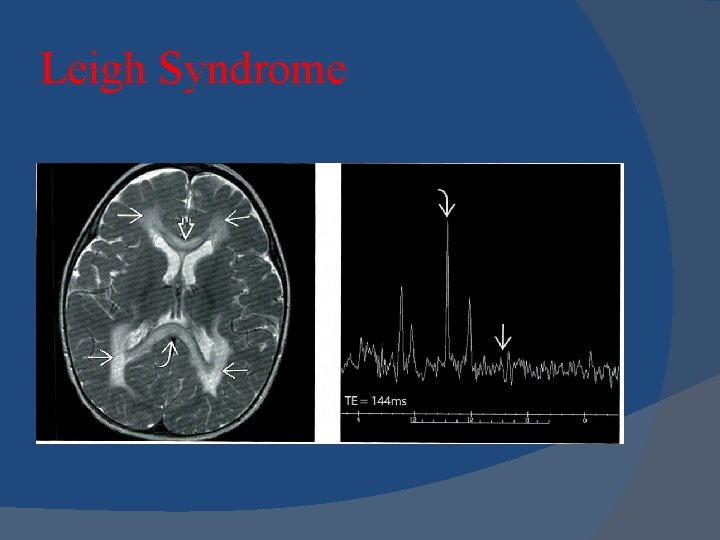 Leigh Syndrome 