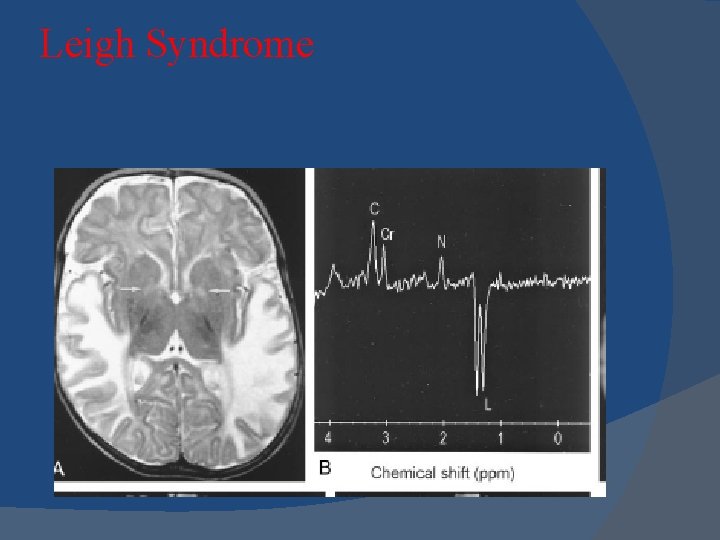 Leigh Syndrome 