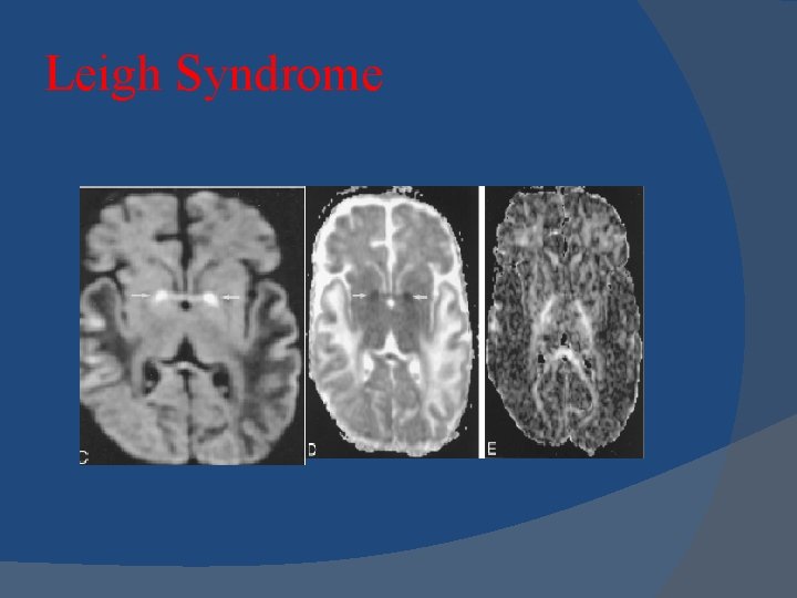 Leigh Syndrome Leigh Syndrome