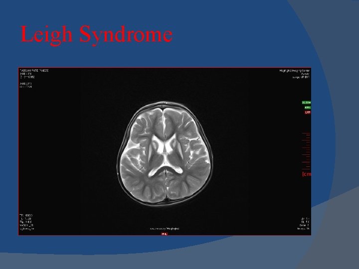 Leigh Syndrome Leigh Syndrome