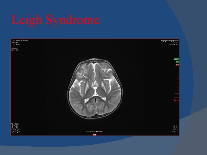 Leigh Syndrome Leigh Syndrome