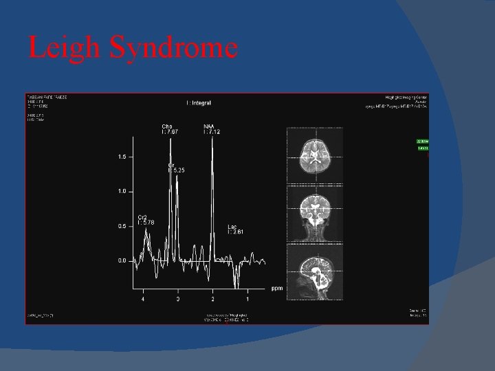 Leigh Syndrome 