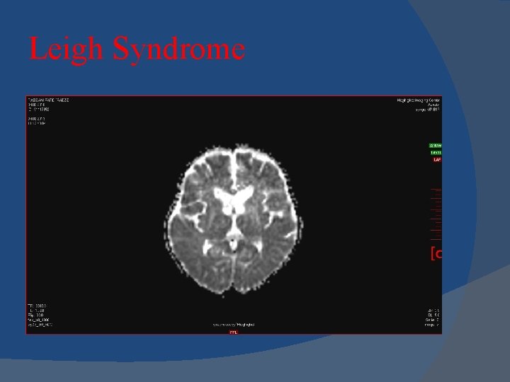 Leigh Syndrome 