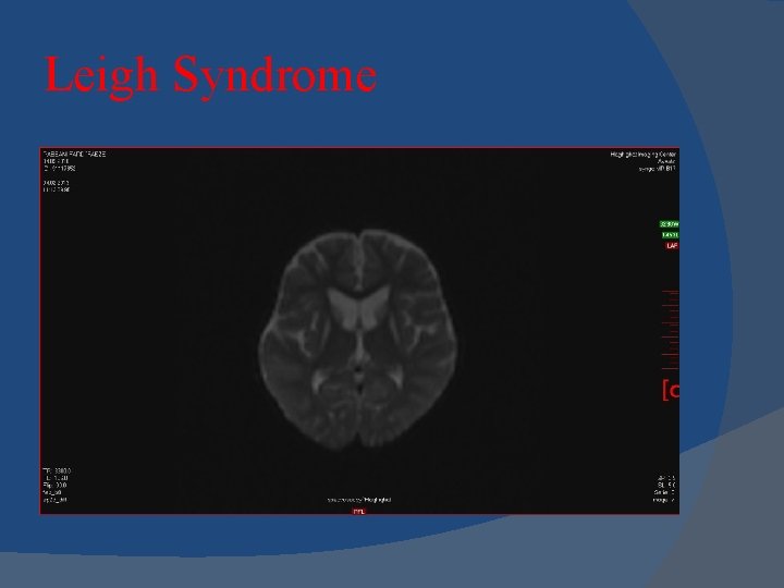 Leigh Syndrome 