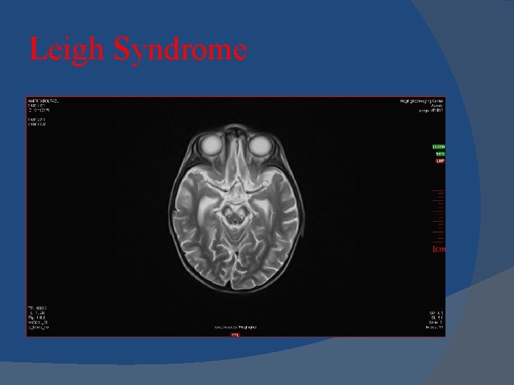 Leigh Syndrome 