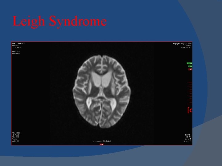 Leigh Syndrome 