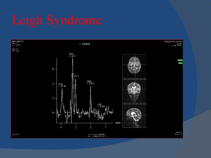 Leigh Syndrome 