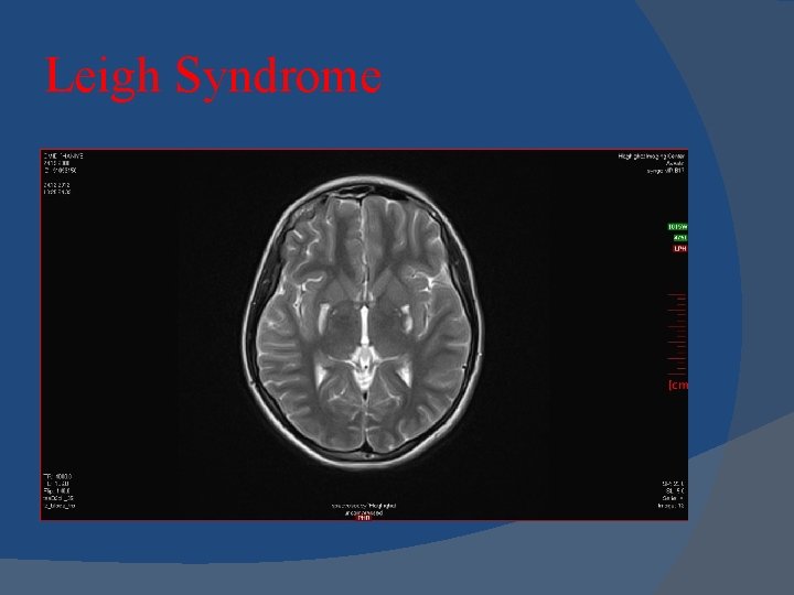 Leigh Syndrome 