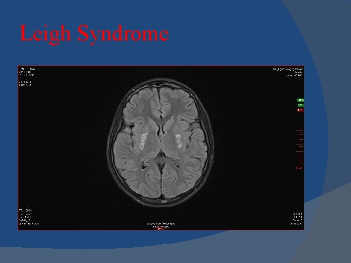 Leigh Syndrome Leigh Syndrome