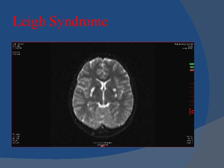 Leigh Syndrome 