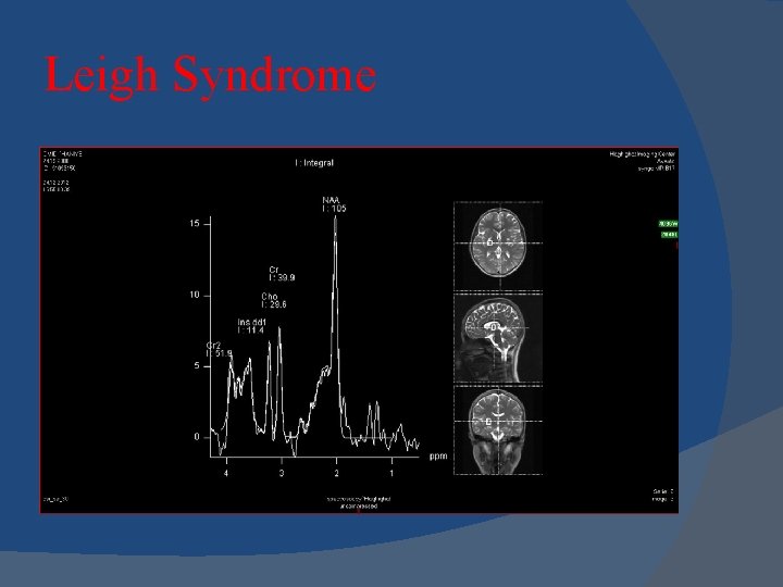 Leigh Syndrome 