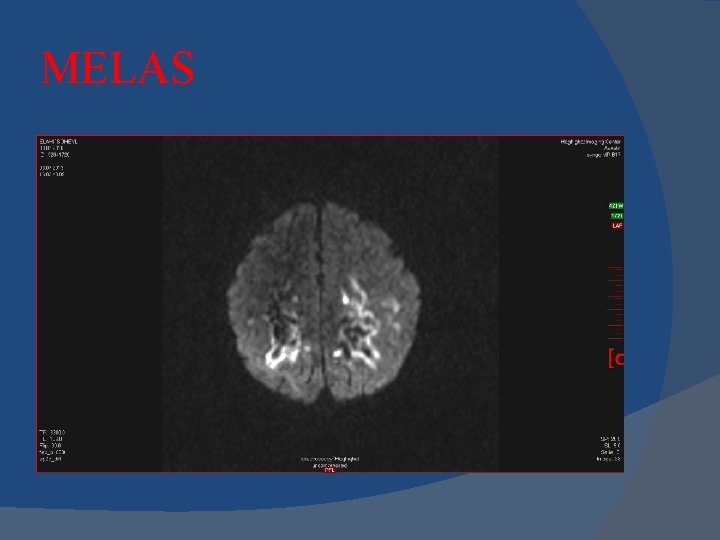 MELAS MELAS
