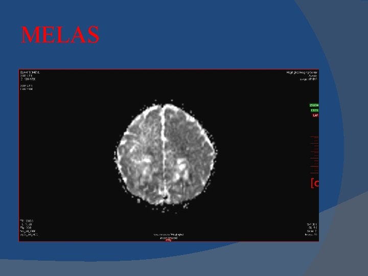 MELAS MELAS