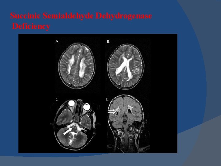 Succinic Semialdehyde Dehydrogenase Deficiency 