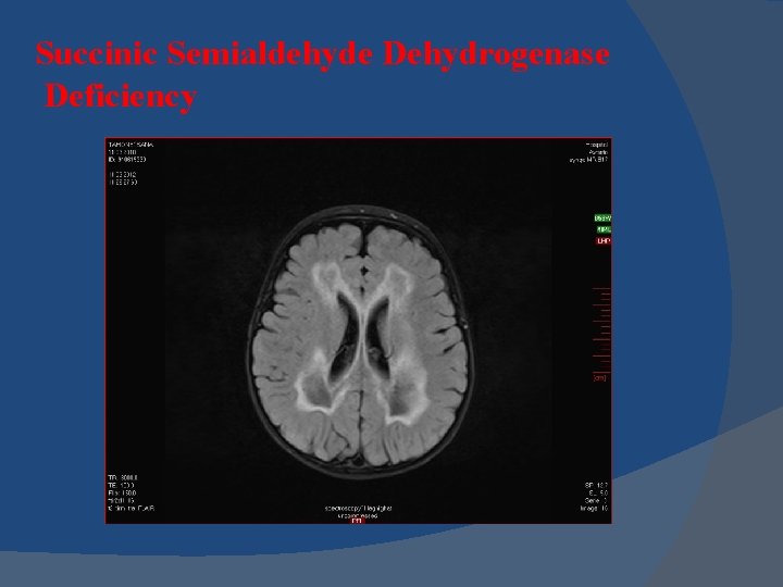 Succinic Semialdehyde Dehydrogenase Deficiency Succinic Semialdehyde Dehydrogenase Deficiency