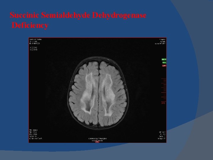 Succinic Semialdehyde Dehydrogenase Deficiency 