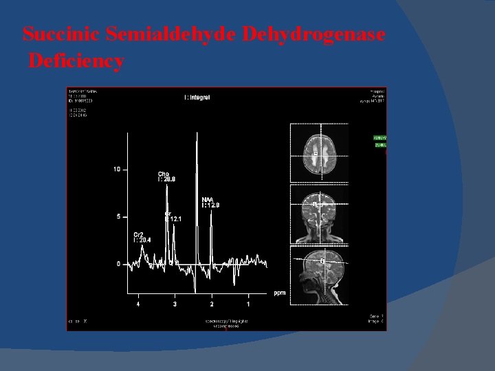 Succinic Semialdehyde Dehydrogenase Deficiency Succinic Semialdehyde Dehydrogenase Deficiency