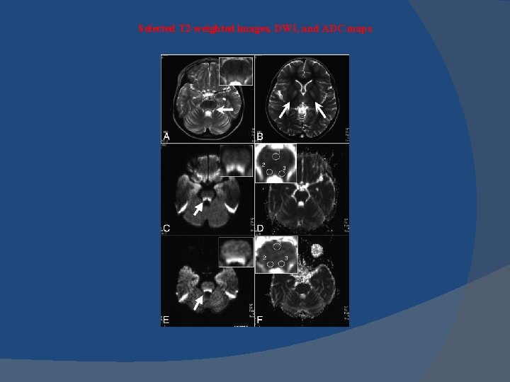 Selected T 2 -weighted images, DWI, and ADC maps 