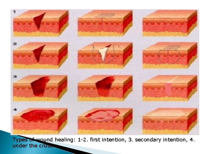 Types of wound healing: 1 -2. first intention, 3. secondary intention, 4. under the