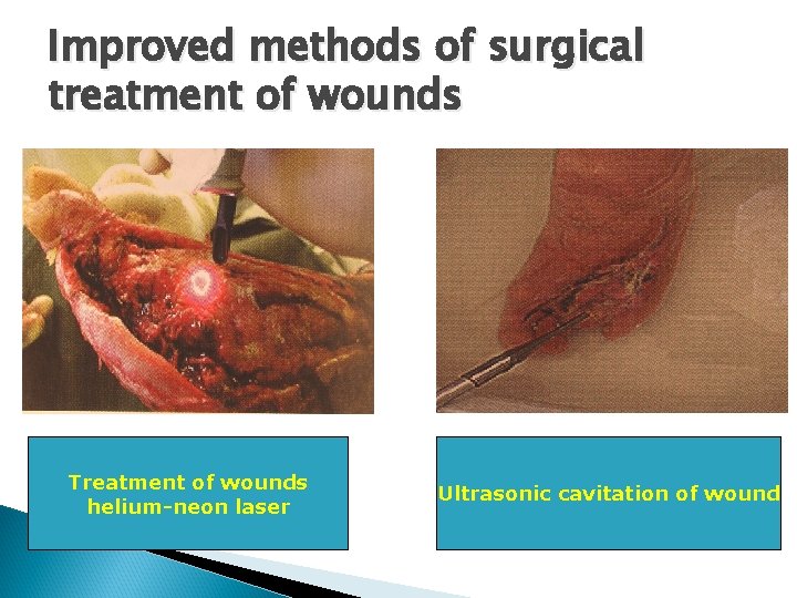 Improved methods of surgical treatment of wounds Treatment of wounds helium-neon laser Ultrasonic cavitation