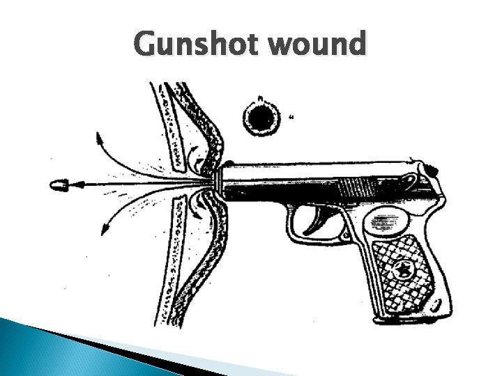 Gunshot wound 