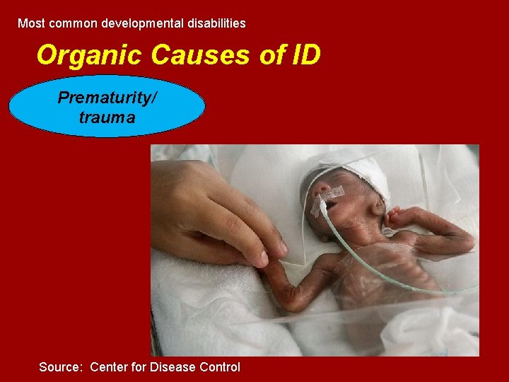 Most common developmental disabilities Organic Causes of ID Prematurity/ trauma Source: Center for Disease Most common developmental disabilities Organic Causes of ID Prematurity/ trauma Source: Center for Disease