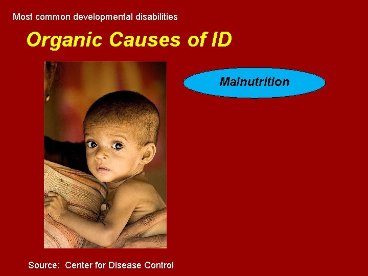 Most common developmental disabilities Organic Causes of ID Malnutrition Source: Center for Disease Control Most common developmental disabilities Organic Causes of ID Malnutrition Source: Center for Disease Control