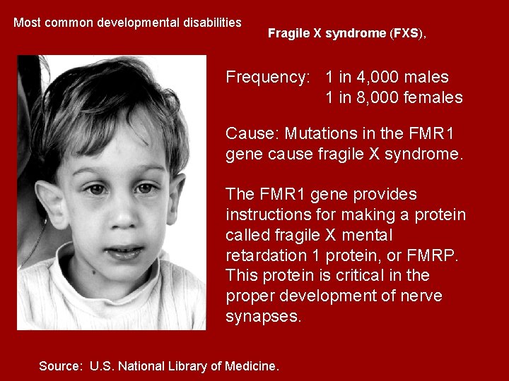 Most common developmental disabilities Fragile X syndrome (FXS), Frequency: 1 in 4, 000 males Most common developmental disabilities Fragile X syndrome (FXS), Frequency: 1 in 4, 000 males