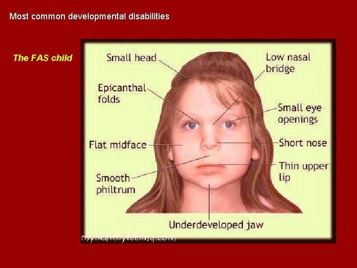 Most common developmental disabilities The FAS child Most common developmental disabilities The FAS child