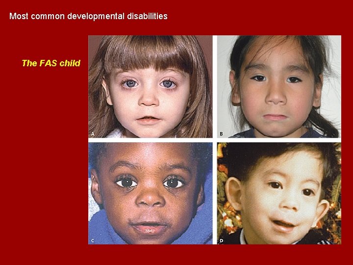 Most common developmental disabilities The FAS child Most common developmental disabilities The FAS child
