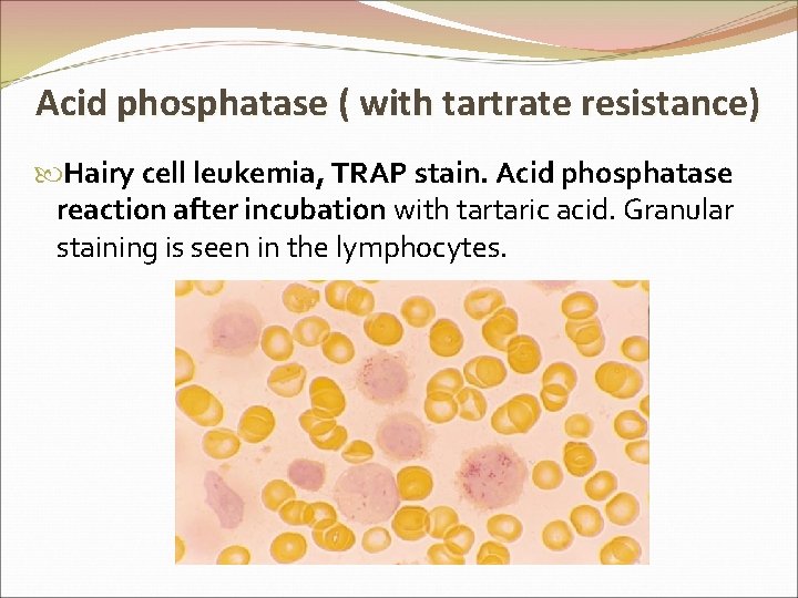 Acid phosphatase ( with tartrate resistance) Hairy cell leukemia, TRAP stain. Acid phosphatase reaction