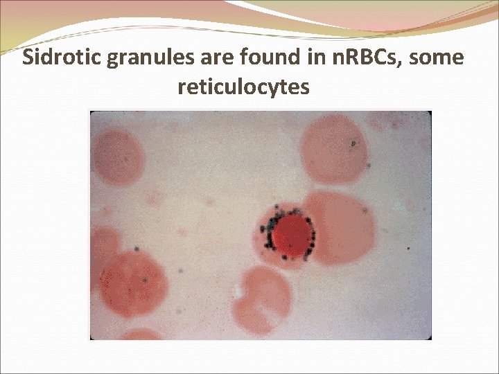Sidrotic granules are found in n. RBCs, some reticulocytes 