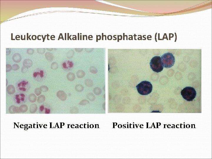 Leukocyte Alkaline phosphatase (LAP) Negative LAP reaction Positive LAP reaction 