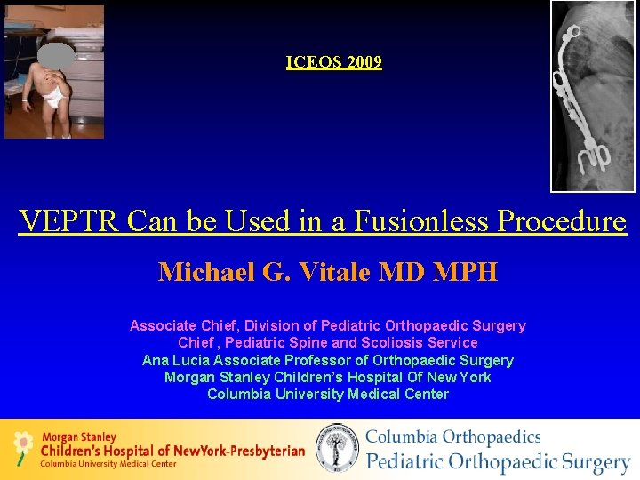 ICEOS 2009 VEPTR Can be Used in a Fusionless Procedure Michael G. Vitale MD