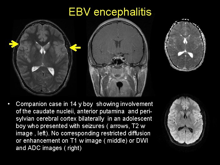 EBV encephalitis • Companion case in 14 y boy showing involvement of the caudate