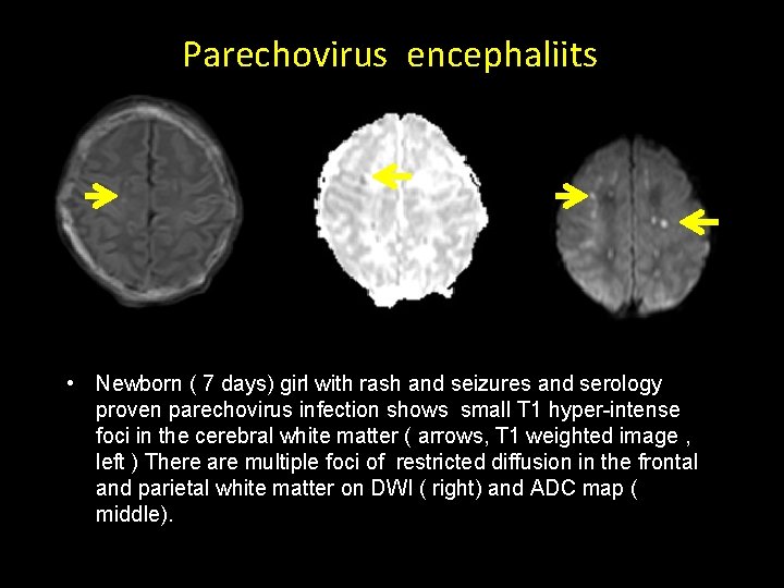 Parechovirus encephaliits • Newborn ( 7 days) girl with rash and seizures and serology Parechovirus encephaliits • Newborn ( 7 days) girl with rash and seizures and serology