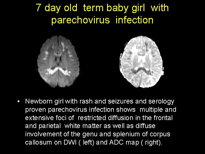 7 day old term baby girl with parechovirus infection • Newborn girl with rash 7 day old term baby girl with parechovirus infection • Newborn girl with rash