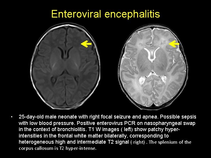 Enteroviral encephalitis • 25 -day-old male neonate with right focal seizure and apnea. Possible