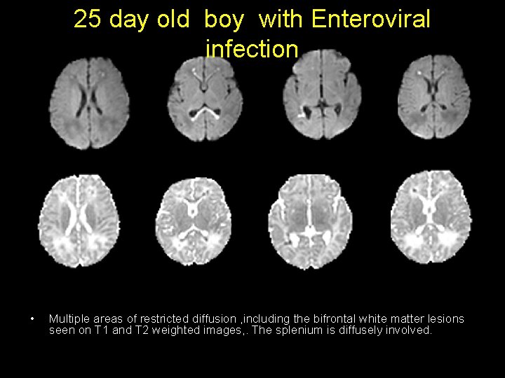 25 day old boy with Enteroviral infection • Multiple areas of restricted diffusion , 25 day old boy with Enteroviral infection • Multiple areas of restricted diffusion ,