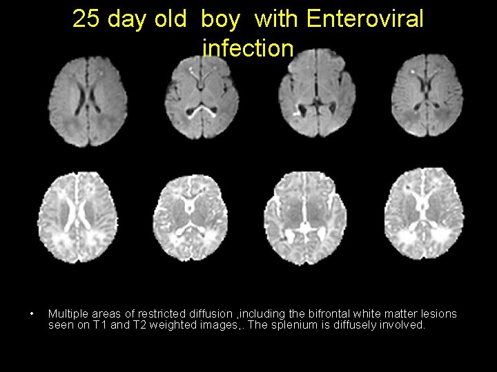 25 day old boy with Enteroviral infection • Multiple areas of restricted diffusion ,